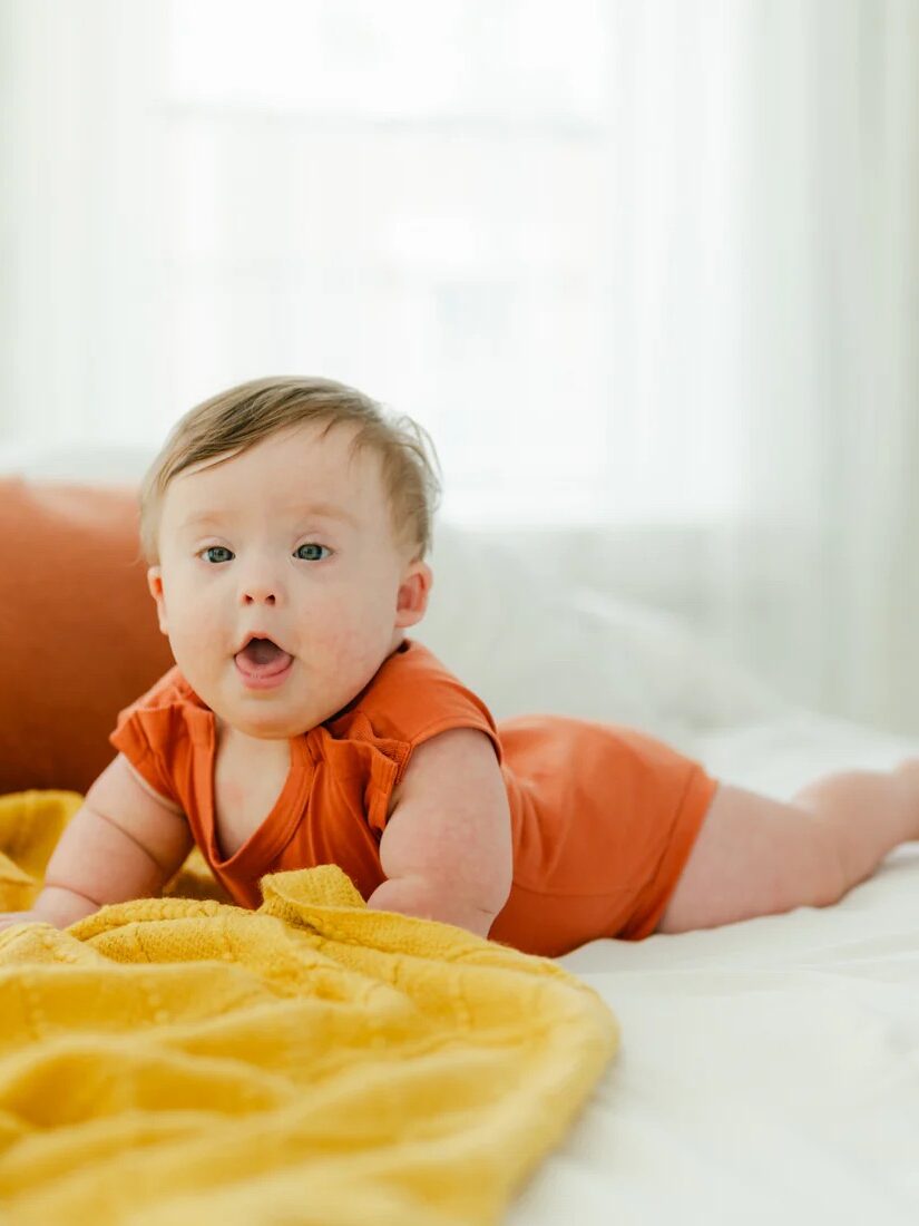 A baby with Down syndrome in an orange onesie lies on their stomach on a bed with a yellow blanket, looking toward the camera in a brightly lit room.